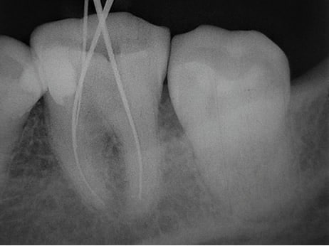 Before-Endodontia