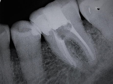 After-Endodontia